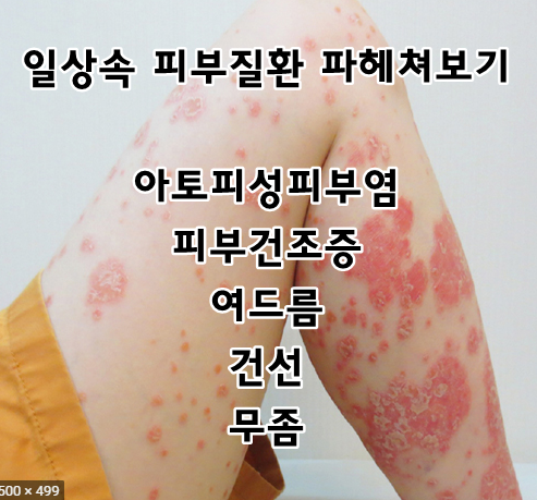  일상속 흔히 접하는 피부질환 - 아토피성피부염, 무좀, 피부건조증, 건선 , 여드름 파헤쳐 보기