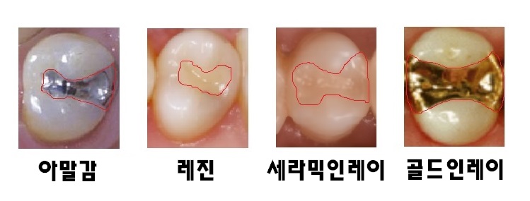 충전치료와 인레이 치료를 받은 치아의 사진