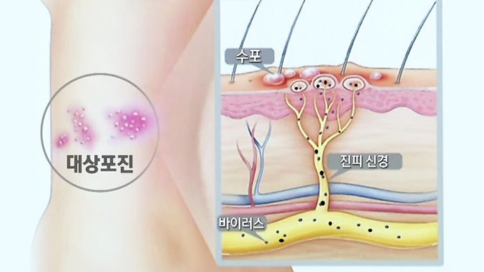  대상포진 초기증상 원인 특징 자가진단 정보 총정리