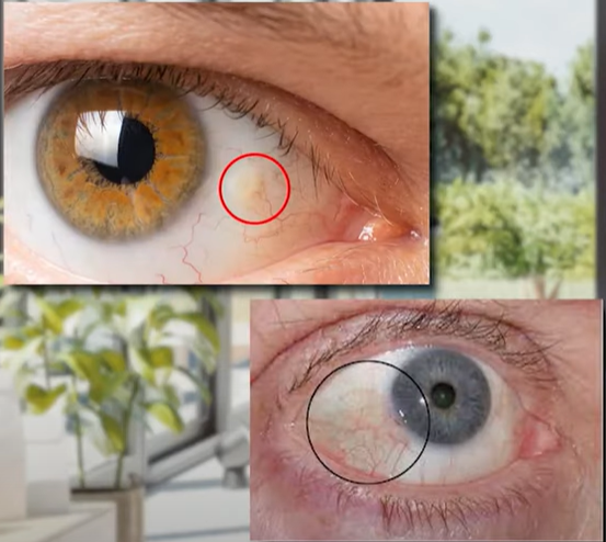 안구 안에 있는 노란점이 치매노인에게서 발견되는 초기치매 증상이라고 보고된 바 있다.