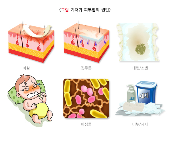  기저귀피부염