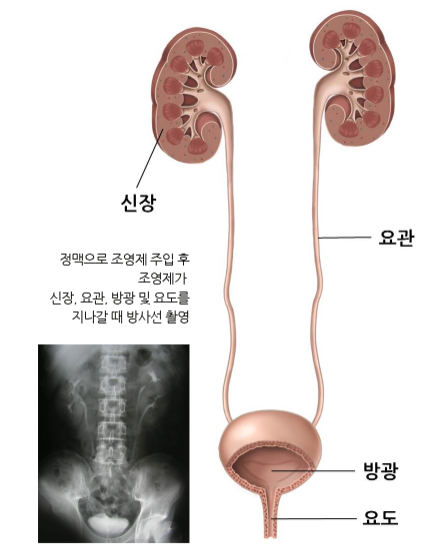 정맥신우조영술_아산병원