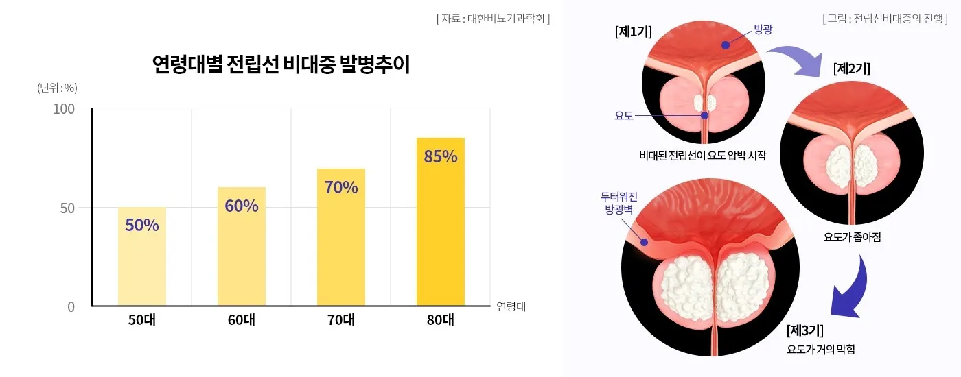 전립선비대증 증상