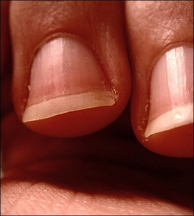 손톱으로 보는 질병 5