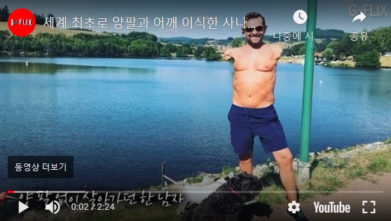  양팔+어깨 이식 한 남자의 세계 최초 이야기