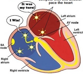 multifocal atrial tachycardia 다소성심방빈맥