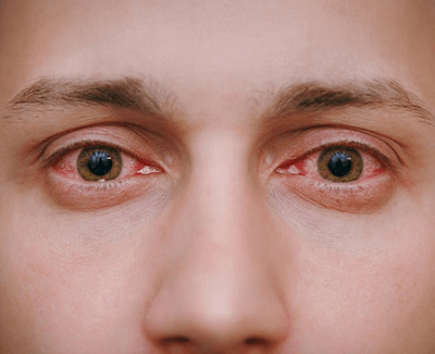 결막염 초기 증상 눈 충혈