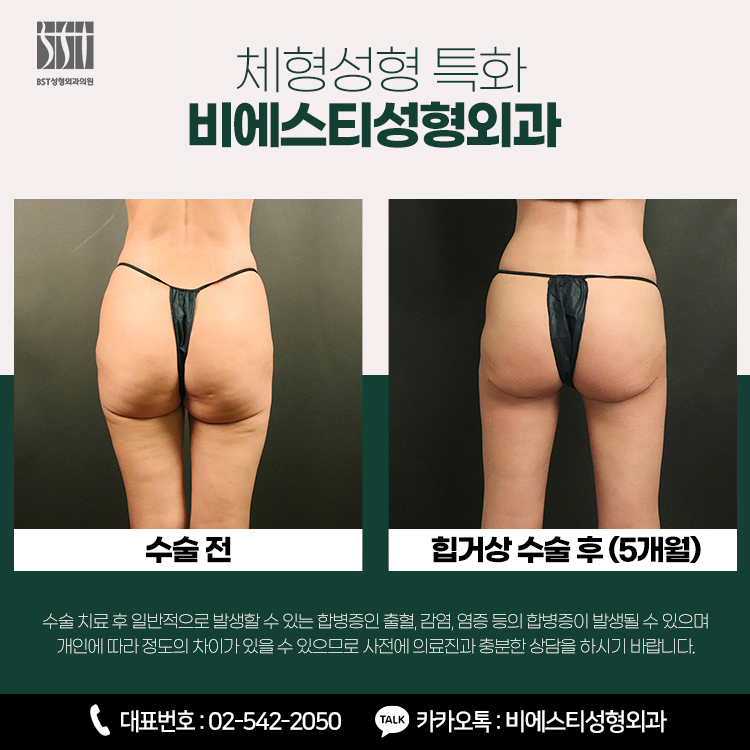 처진엉덩이수술 힙업거상 전후 비교 사진