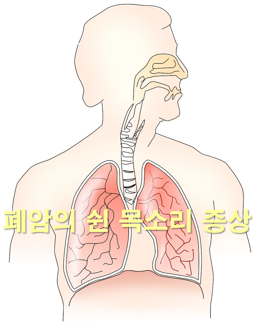  폐암의 쉰 목소리 증상 원인은 성대와 주변 조직의 침범