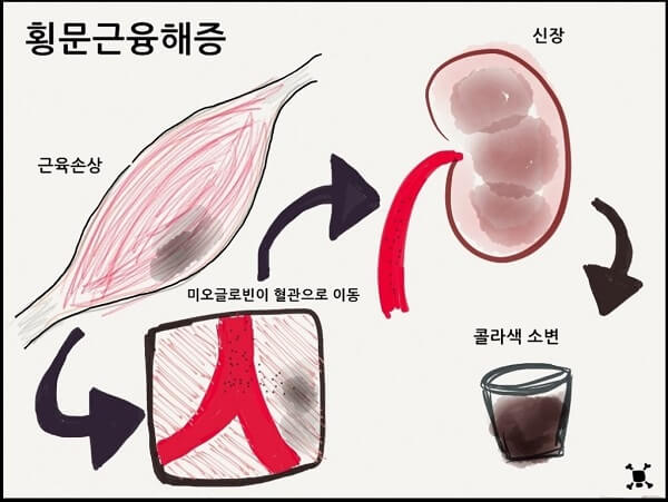  과격한 운동으로 오는 근육이 녹는 '횡문근융해증' 조심 ㅣ 독감에 걸린 줄 알았는데..VIDEO:.He thought he had the flu. Then, his urine turned 'the color of Coca-Cola.'