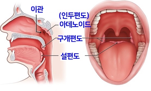 편도염 원인 증상 빨리 낫는법