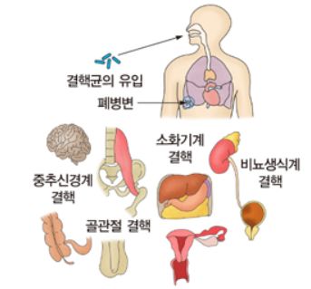 결핵 증상