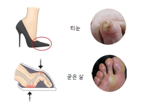  티눈 없애는 방법,사마귀 제거 방법
