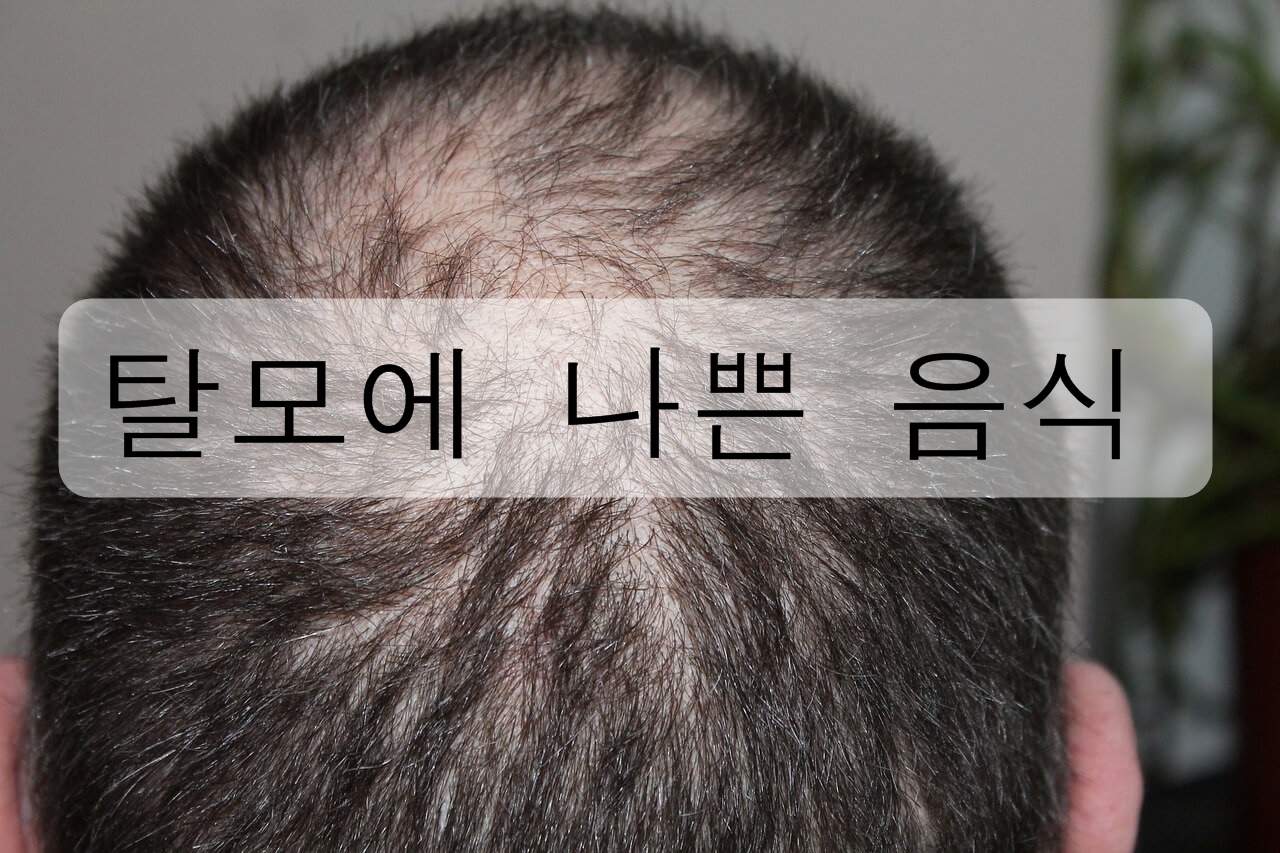  탈모에 나쁜 음식을 알아보자! (탈모 예방 습관)