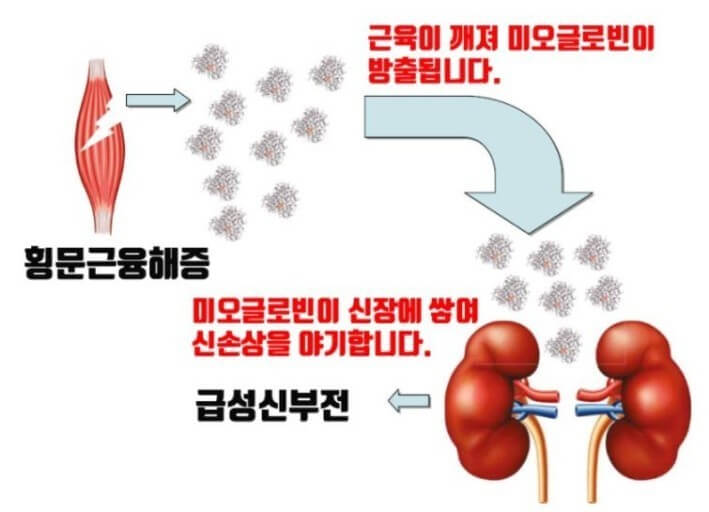 횡문근융해증의 위험 