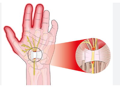 손목터널증후군