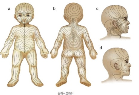 블라쉬코 라인 이미지