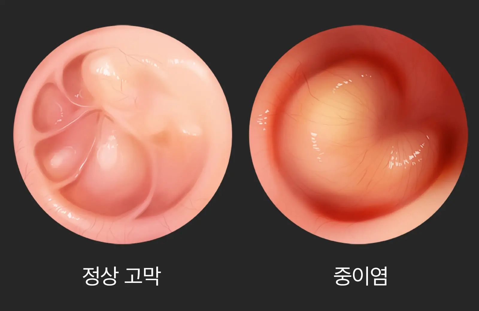  어금니 꽉 깨물면 귀가 아픈 이유: 중이염일까?