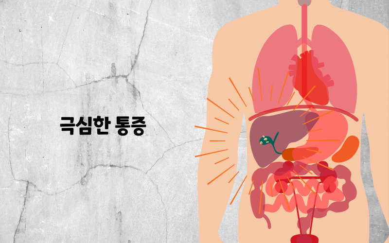 담석제거수술 후기 담석증 명치 등 통증