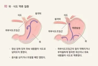 역류성 식도염 원인 초기증상 예방하는 방법_39