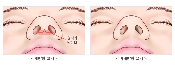 코끝성형 수술 방법 비절개 절개 성형술