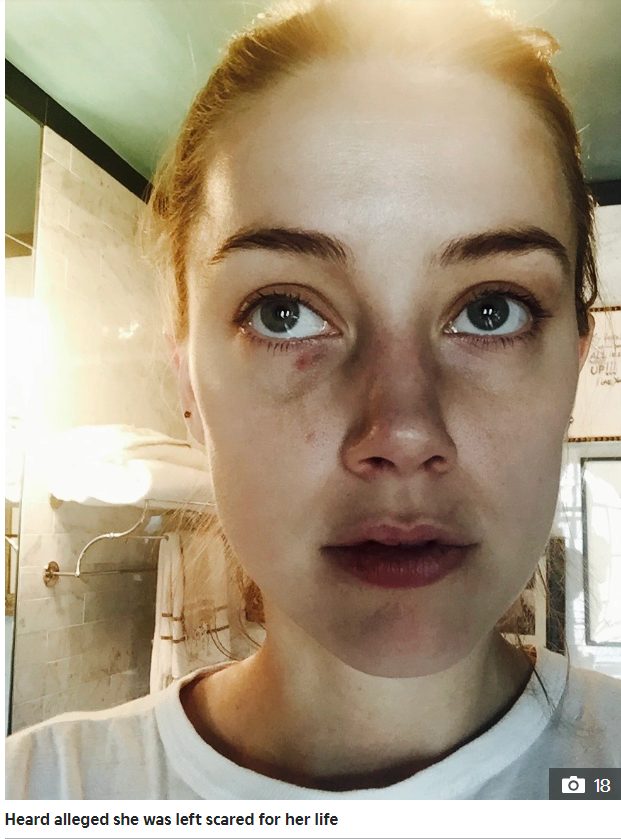 The Sun Amber Heard Face Injuries