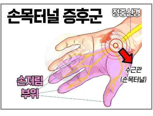 손목터널증후군으로-발생할-수-있는-손저림-부위