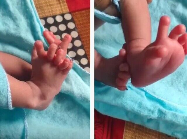 손가락 14개 &#44; 발가락 12개 가지고 태어난 인도 아기... 다지증이란?