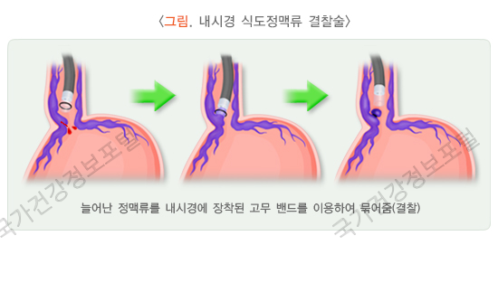 내시경을 통한 정맥류 결찰술