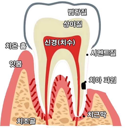 잇몸 퇴출 - 치경부 마모증 - 치아가 파이는 이유