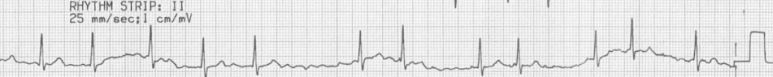 atrial fibrillation 심방세동