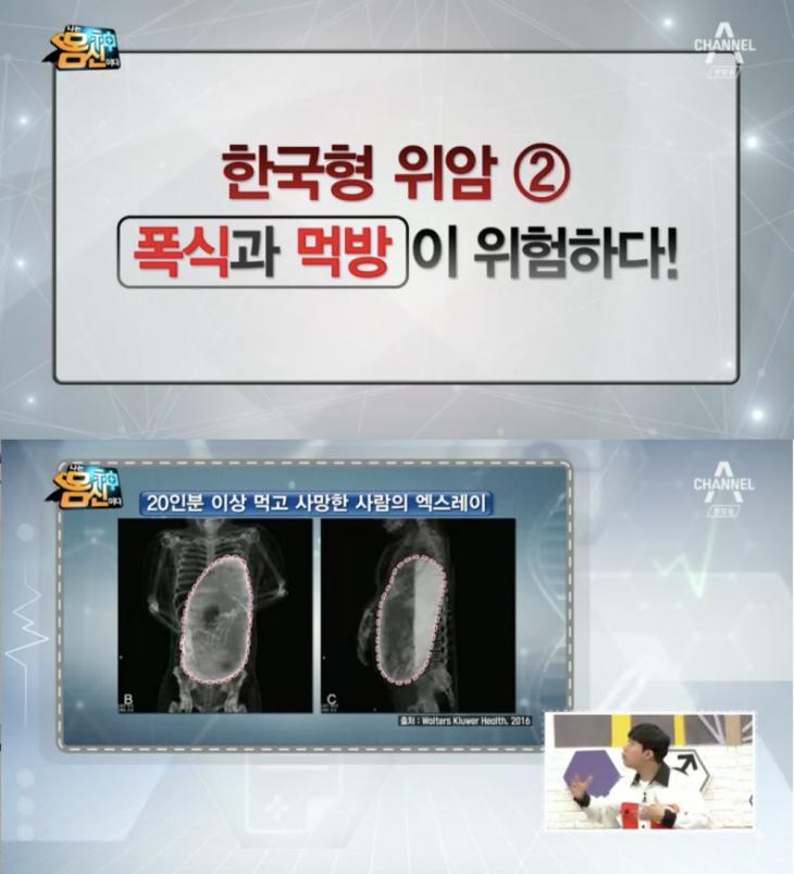  폭식하거나 먹방한 위모습 ㄷㄷㄷㄷ