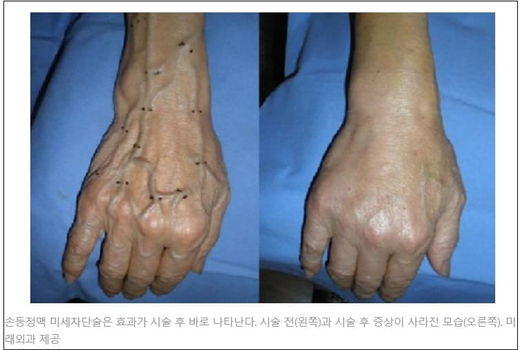  손등 핏줄이 울퉁불퉁...‘이 동작’ 하면 줄어든다