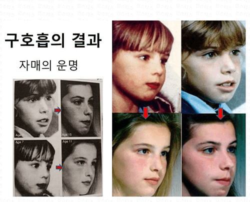  편도 아데노이드 비대증 얼굴 증상 수술방법