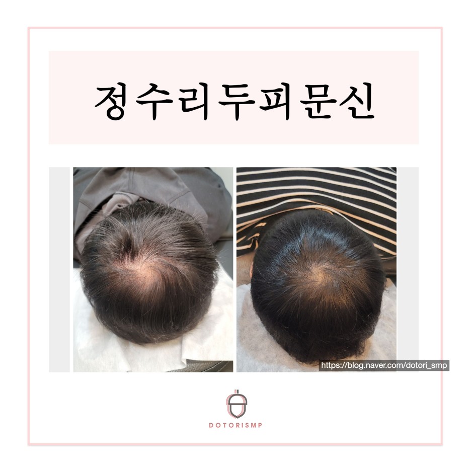  정수리탈모는 부산 두피문신이 모발이식보다 효과 좋습니다.