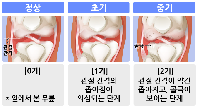 무릎관절염