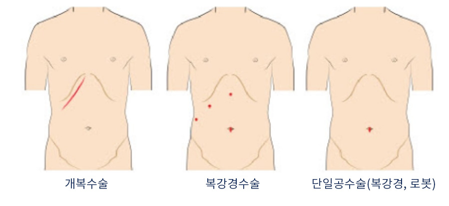 쓸개(담낭) 제거수술