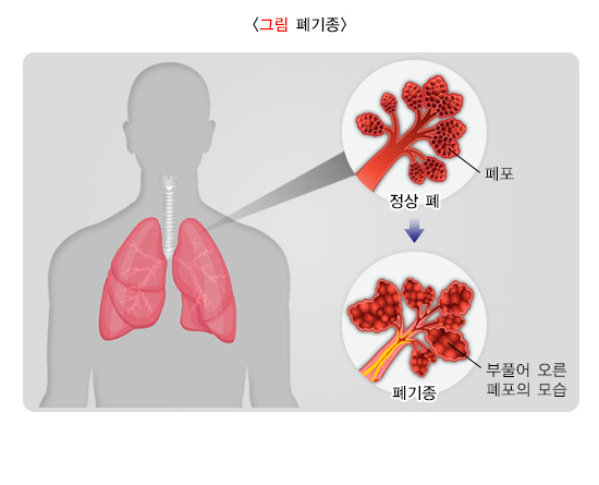  직업성 만성폐쇄성폐질환