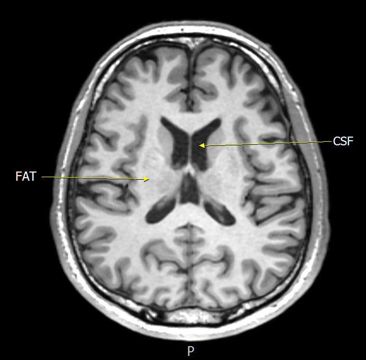 뇌(BRAIN) MRI T1WI에서의 FAT과 CSF 
출처 : 본인이 근무하는 병원 영상 (이름삭제)