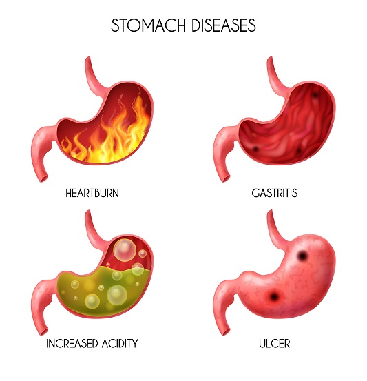 Chronic-gastritis