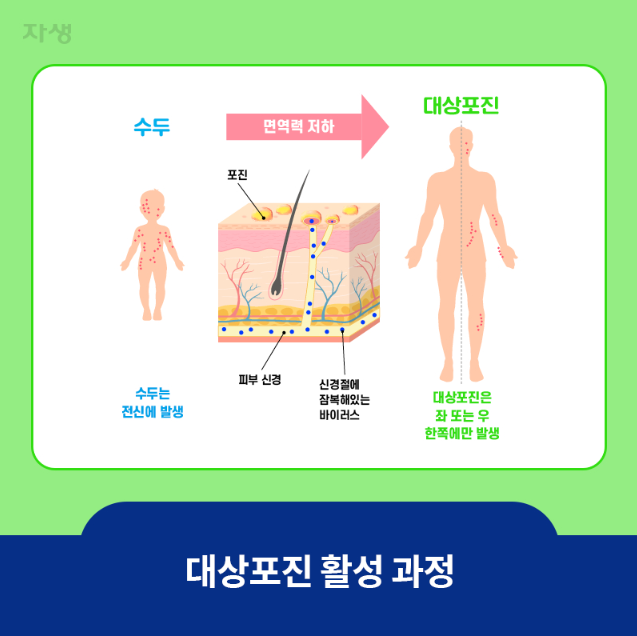 대상포진 활성과정