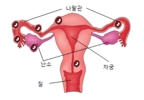  자궁외임신 증상과 치료방법