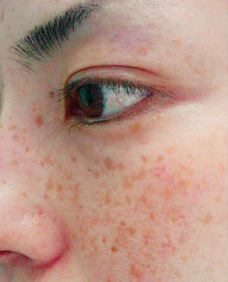 기미를 옅게 만드는 최고의 영양제