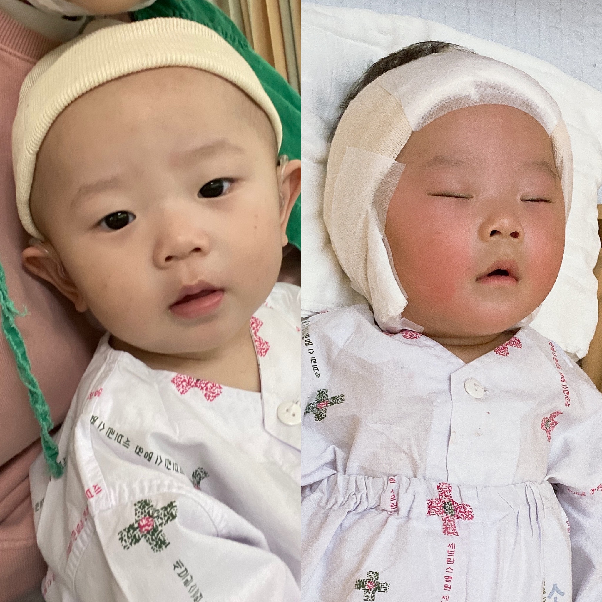  인공 와우 수술 후기 (입원 및 수술)
