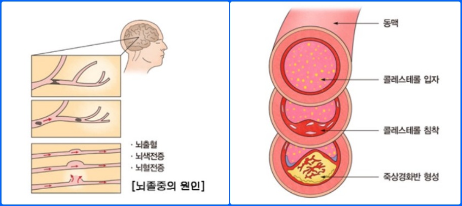  뇌혈관 질환/ 뇌졸중, 뇌경색, 뇌출혈 초기 증상 및 예방법