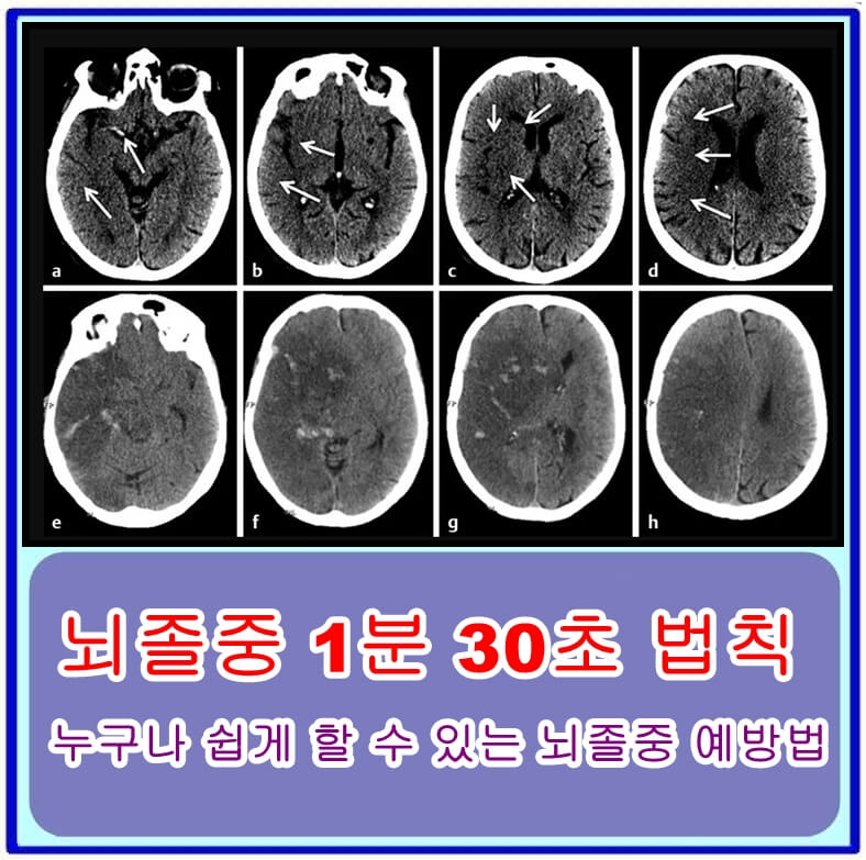  뇌졸중 1분 30초 법칙, 누구나 쉽게 할 수 있는 뇌졸중 예방법