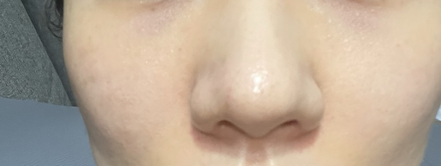 코조각주사 콧볼축소 효과 5