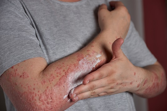 Poison-ivy-dermatitis