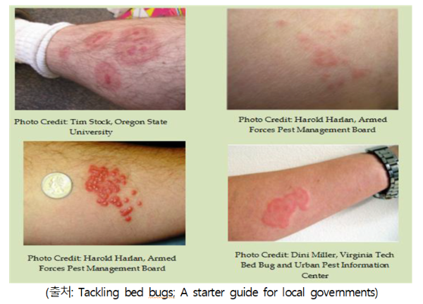 Bed Bug 빈대 물린자국 증상 찾는법 퇴치법 예방법