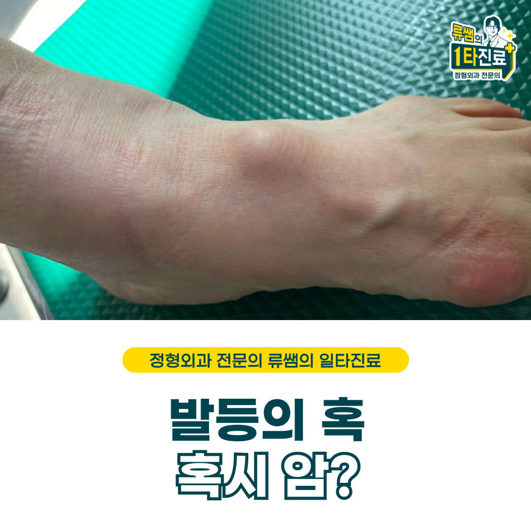  발등에 혹이 생겼어요/발등혹/발등결절종/혹시 암?(의사작성)